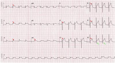 Case Report: ST-Segment Elevation in a Man With Acute Pericarditis